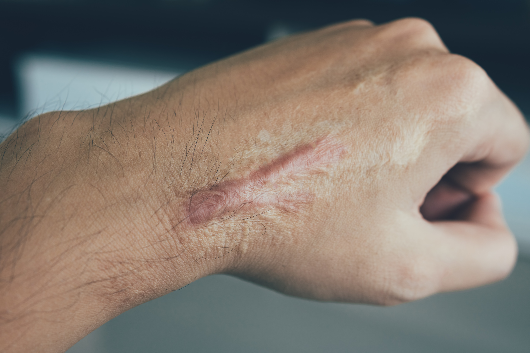 hand scar