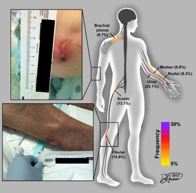 Heat map summarizing nerve damage sites from severe COVID