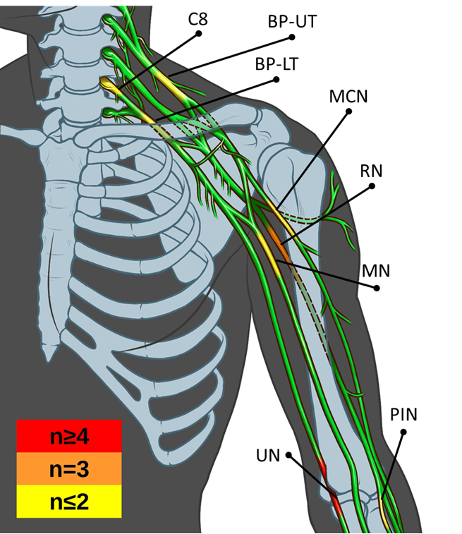 Peripheral Nerve damage