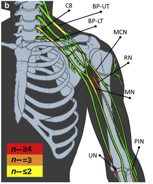 Nerve Damage Illustration