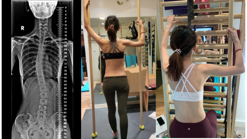 Shidi Lin’s Journey with Scoliosis