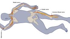 Nerve Damge from Prone Positioning
