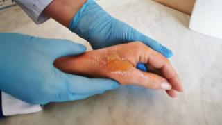 Burn Rehabilitation