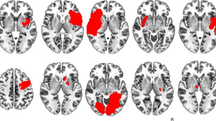 Dr. Jordan Grafman Co-Authors Study on Link Between Brain Lesions and Addiction