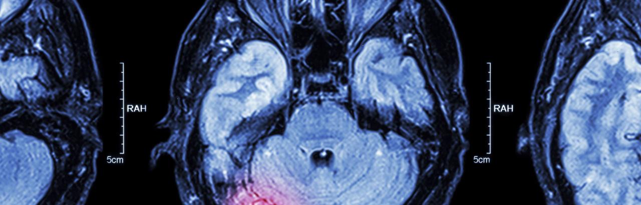 Brain scans in chemo thearpy