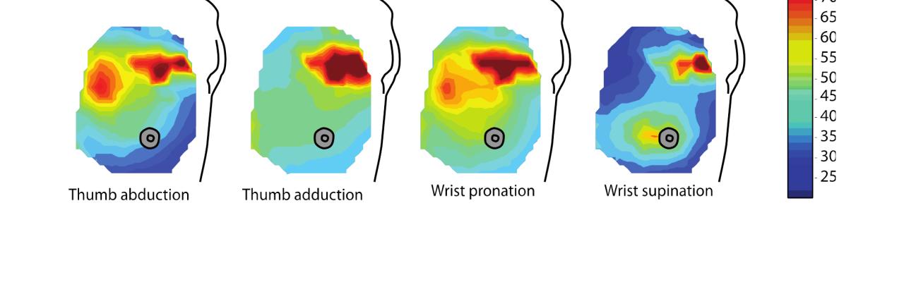 Targeted Muscle Reinnervation Heat Map