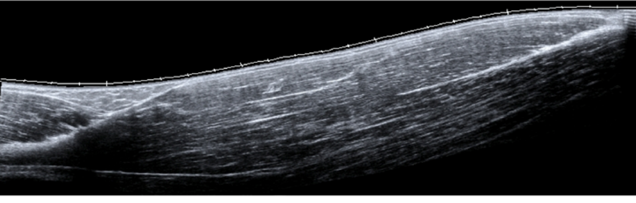 Biceps EFOV Ultrasound