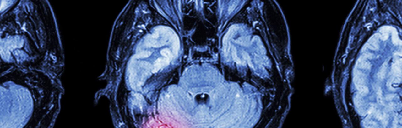 MRI images of a brain