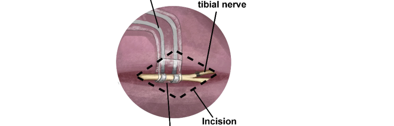 detail of repaired nerve