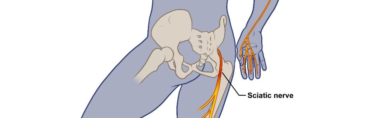 COVID nerve injury map