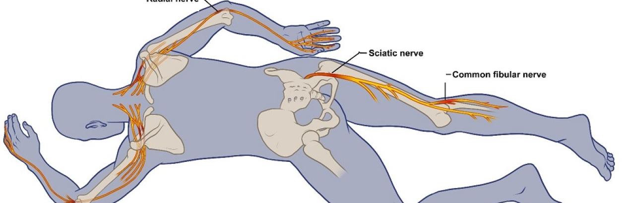 Nerve Damge from Prone Positioning