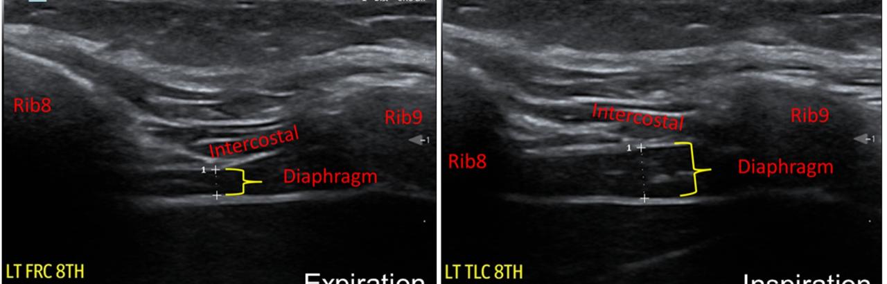 COVID-19 Diaphragm Study black and white photo imagery