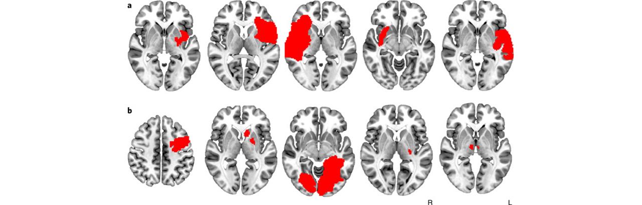 Dr. Jordan Grafman Co-Authors Study on Link Between Brain Lesions and Addiction