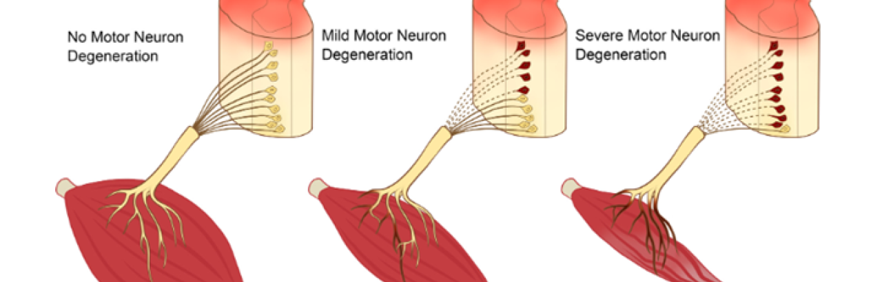Conceptual framework for considering the status of lower motor neuron degeneration affecting key arm muscles that may be re-animated after spinal cord injury via nerve transfer surgery. In scenario C, which affects 30-40% of patients we screen, nerve transfer surgery should be avoided outside of the first 6 months post-injury due to detrimental impact of chronic muscle denervation on recipient muscle targets. However, reconstruction by tendon transfer may be considered.