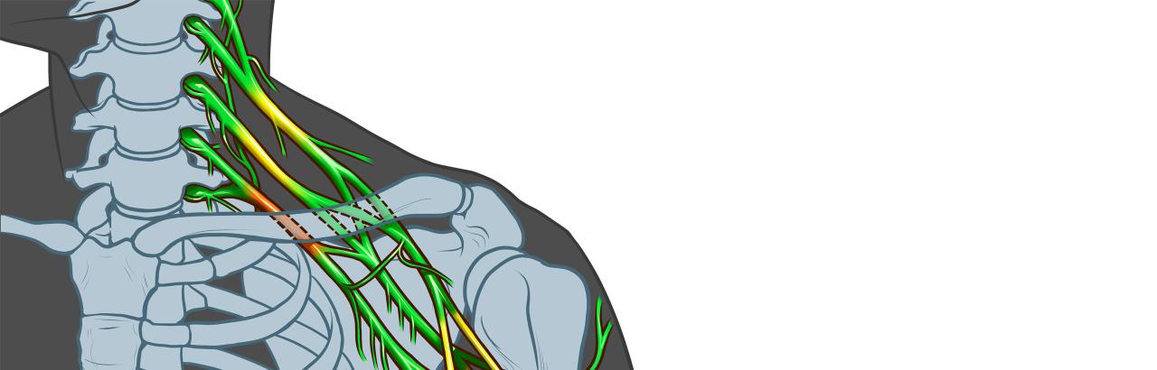 Peripheral Nerve Injury