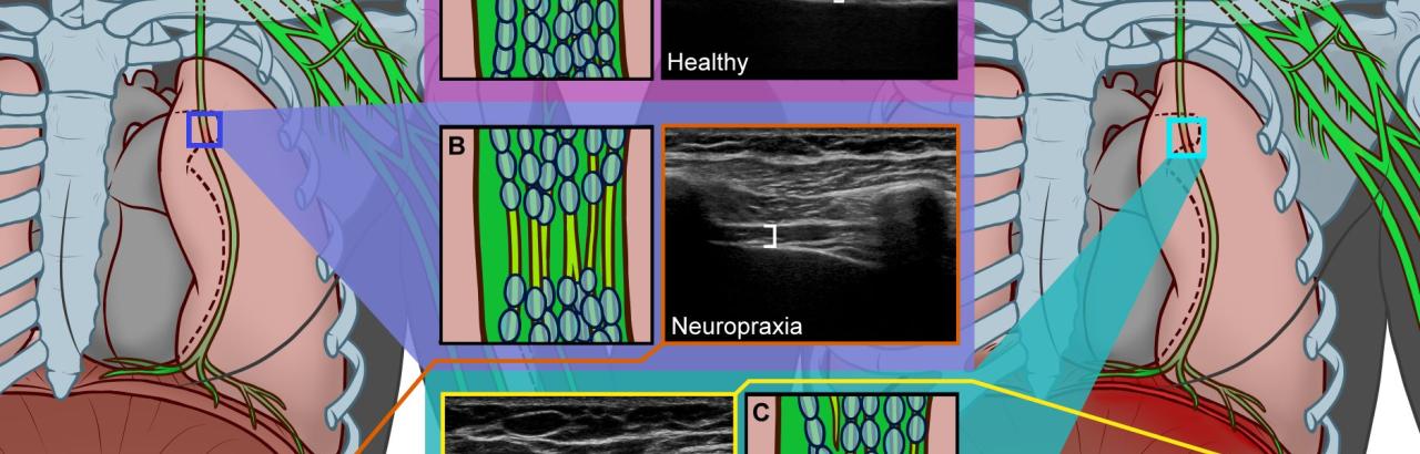 Types of Phrenic Neuropathy 