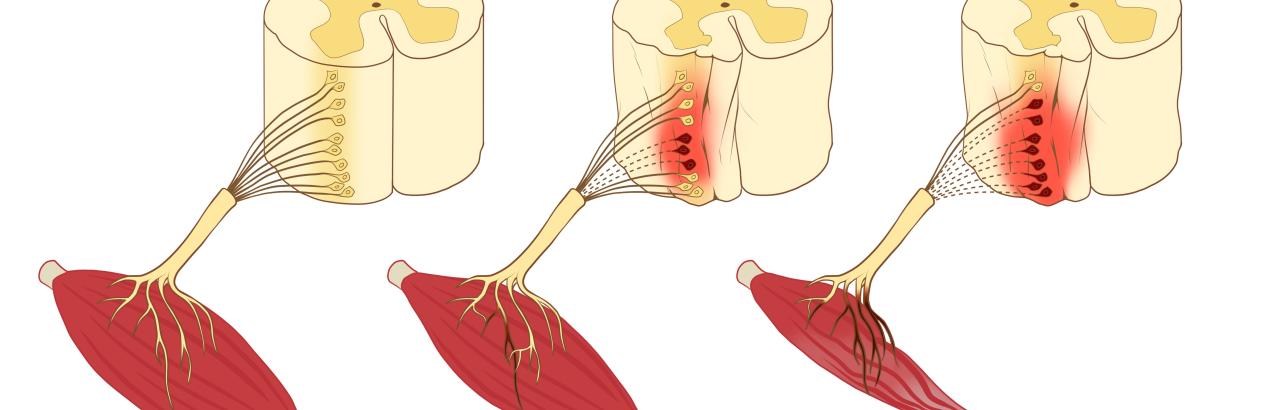 Motor Neuron Loss After SCI