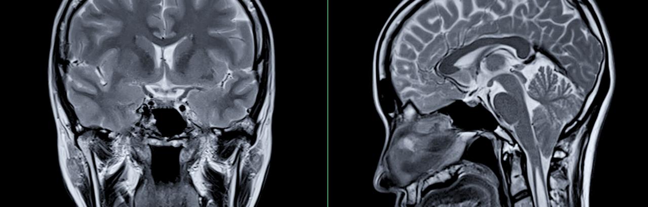 brain injury