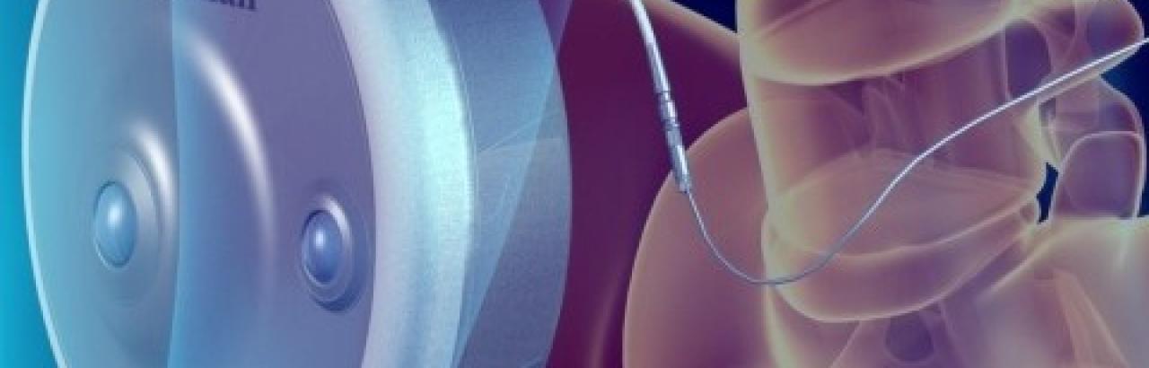 Baclofen Pump inside a spinal cord