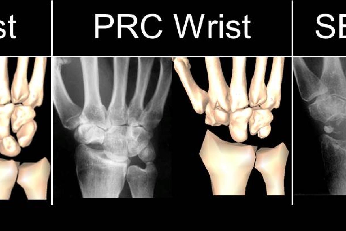 How do wrist surgical salvage procedures limit hand strength?