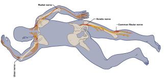 Nerve Damge from Prone Positioning