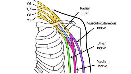 Diagram of nerves relevant in Targeted Muscle Reinnervation surgery