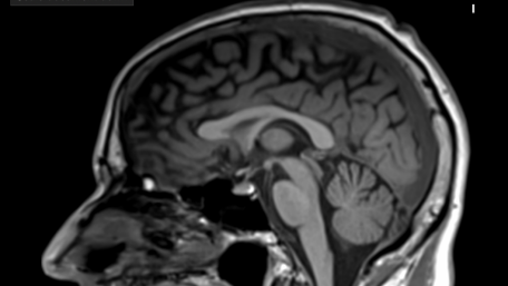 MRI is involved