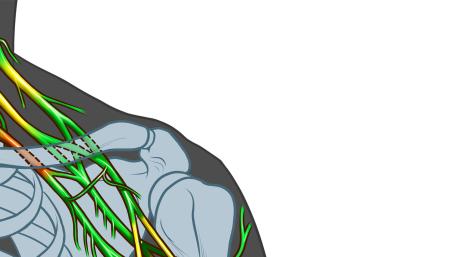 Peripheral Nerve Injury