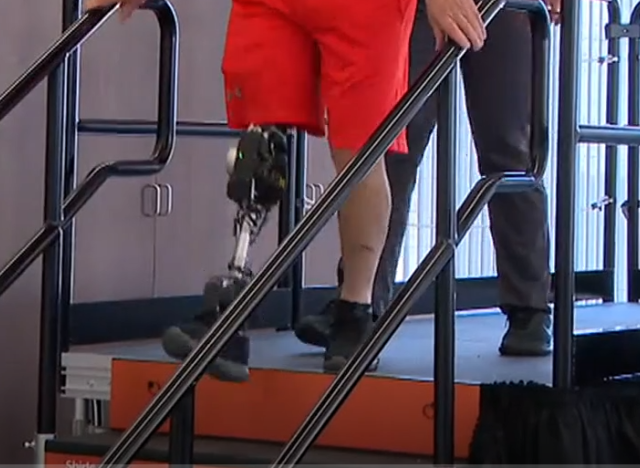 patient walking with new ai powered bionic leg