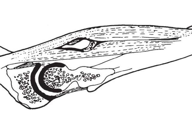illustration of heterotopic ossification