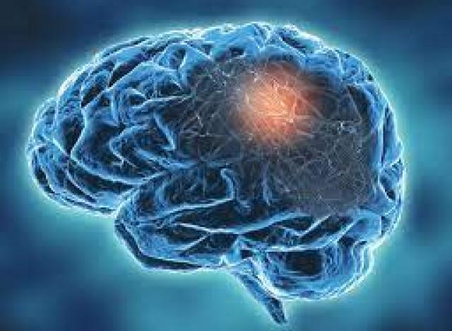 Functional Neurological Disorder image