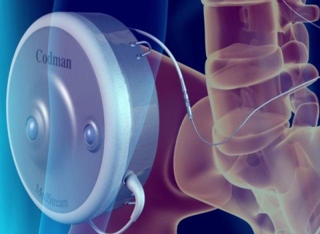 Baclofen Pump inside a spinal cord