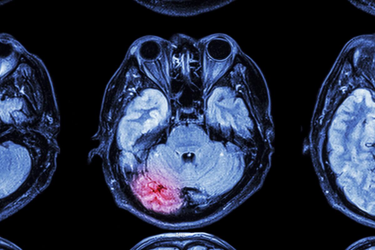MRI images of a brain