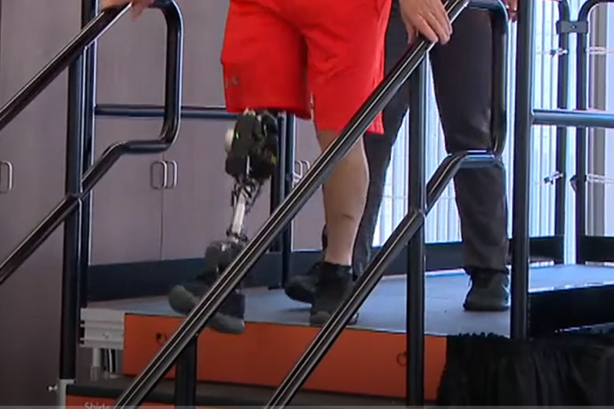 patient walking with new ai powered bionic leg
