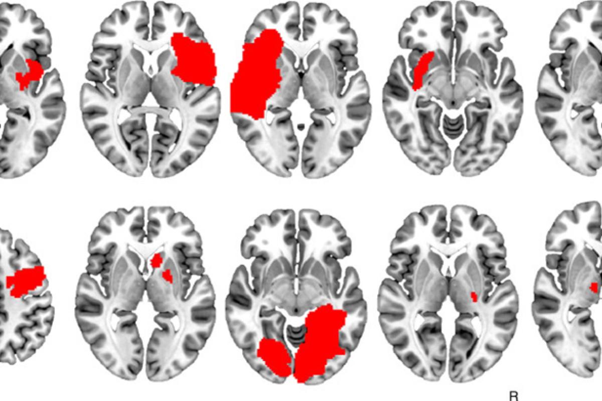 Dr. Jordan Grafman Co-Authors Study on Link Between Brain Lesions and Addiction