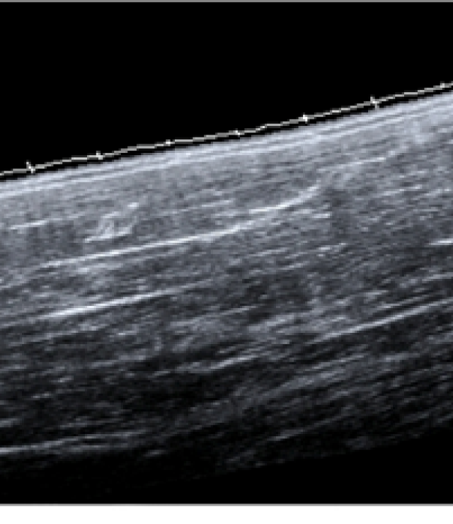 Biceps EFOV Ultrasound