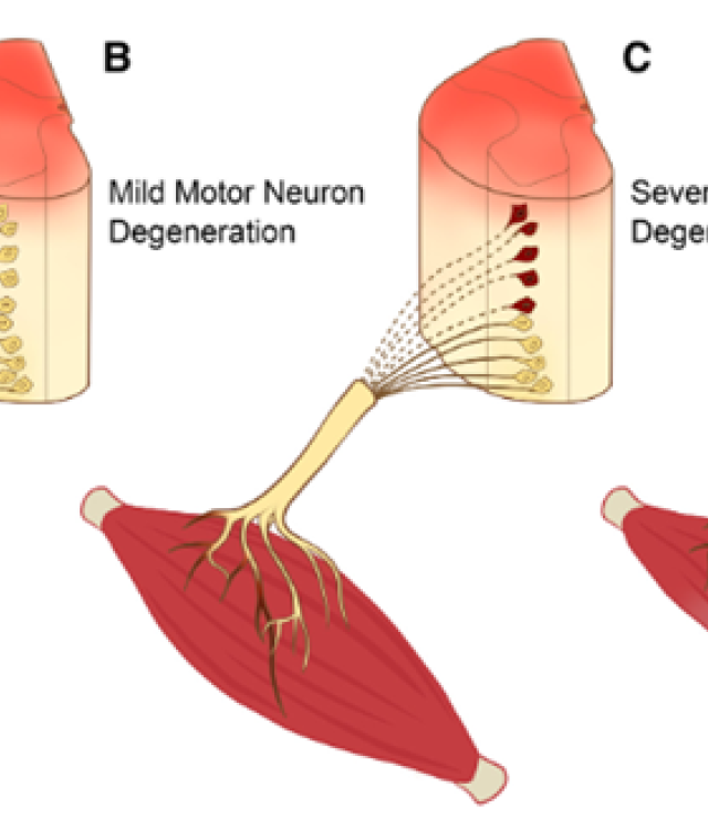 Conceptual framework for considering the status of lower motor neuron degeneration affecting key arm muscles that may be re-animated after spinal cord injury via nerve transfer surgery. In scenario C, which affects 30-40% of patients we screen, nerve transfer surgery should be avoided outside of the first 6 months post-injury due to detrimental impact of chronic muscle denervation on recipient muscle targets. However, reconstruction by tendon transfer may be considered.