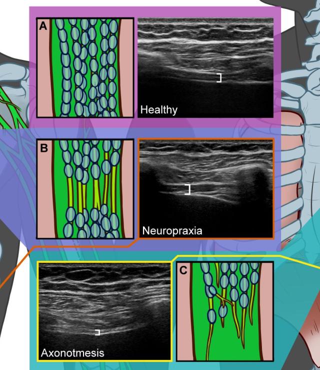 Types of Phrenic Neuropathy