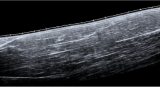 Biceps EFOV Ultrasound