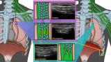 Types of Phrenic Neuropathy