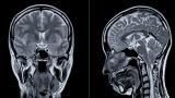 brain scan